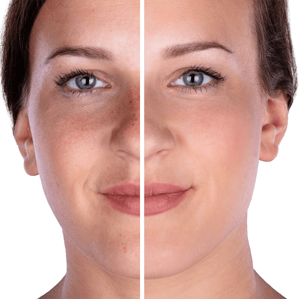 before & after microdermabrasion